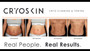 Cryoskin-Slimming 5 session Pack